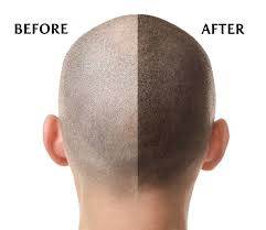 Scalp Micropigmentation Care by Exfoliation